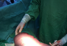 INTERVENŢIE COMPLEXĂ LA SPITALUL JUDEŢEAN DIN BAIA MARE: Splină de 6,5 kilograme, extirpată de la o femeie de 48 de ani