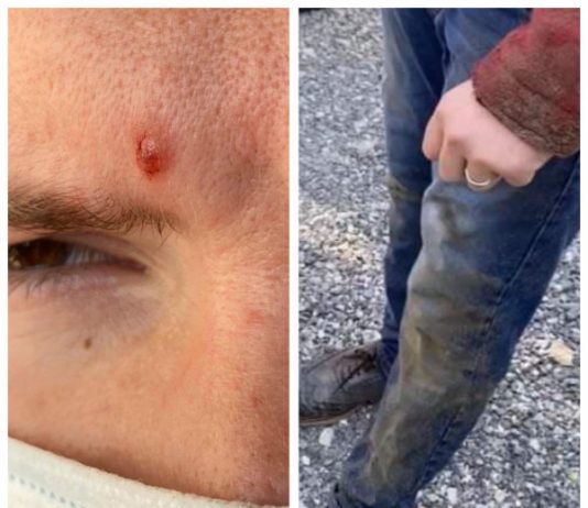 ȘTIRE CITITORI – FOTO EXCLUSIV: În Borșa, o artistă de muzică populară și soțul ei atacați cu pietre, agresați fizic și verbal