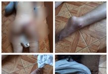 IMAGINI ȘOCANTE: Femeie cu răni îngrozitoare pe corp trimisă acasă de la UPU a Spitalului Sighet după o oră și jumătate fără niciun tratament
